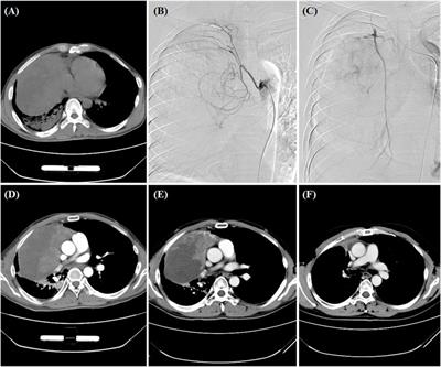 The safety and efficacy of oxaliplatin-loaded drug-eluting beads transarterial chemoembolization for the treatment of unresectable or advanced lung cancer